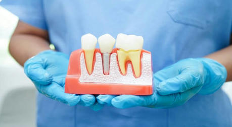 Cost of Dental Implants in the US: A Comprehensive Analysis and Guide
